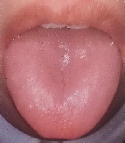 舌苔白色